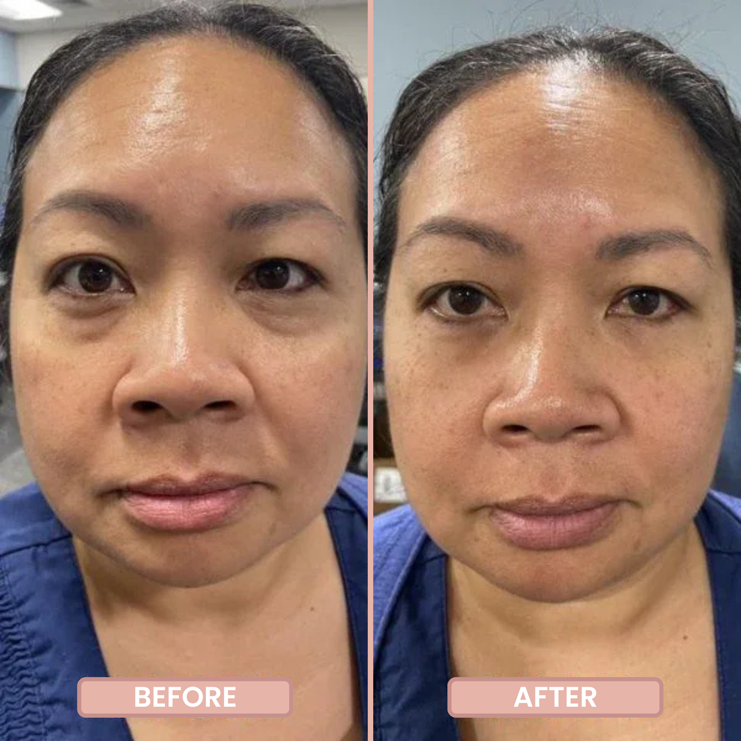 InstantFirm Eye Patches